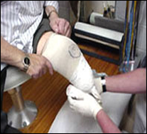 A patient adjusting to a new prosthetic limb during rehabilitation